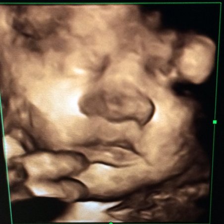 38wk scan